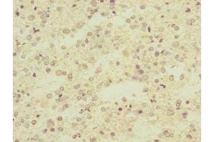 Immunohistochemistry of paraffin-embedded human glioma using ABIN7143097 at dilution of 1:100 (ARPC5 antibody  (AA 1-154))