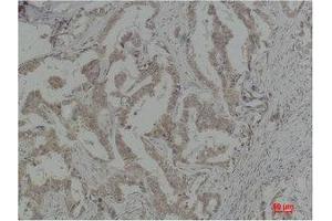 Immunohistochemistry (IHC) analysis of paraffin-embedded Human Breast Carcinoma using Caspase-8 Polyclonal Antibody. (Caspase 8 antibody)