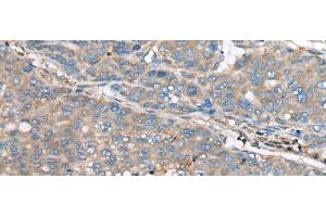 Immunohistochemistry of paraffin-embedded Human liver cancer tissue using GULP1 Polyclonal Antibody at dilution of 1:65(x200) (GULP1 antibody)