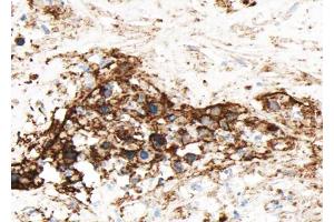 ABIN6268654 at 1/100 staining human liver carcinoma sections by IHC-P. (GJC1 antibody)