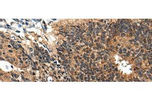Immunohistochemistry of paraffin-embedded Human colorectal cancer tissue using BMPER Polyclonal Antibody at dilution of 1:40(x200) (BMPER antibody)