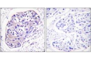 Immunohistochemistry analysis of paraffin-embedded human breast carcinoma tissue, using GRK2 (Ab-29) Antibody. (GRK2 antibody  (AA 14-63))