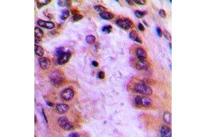 Immunohistochemical analysis of GBP4 staining in human lung cancer formalin fixed paraffin embedded tissue section. (GBP4 antibody  (C-Term))