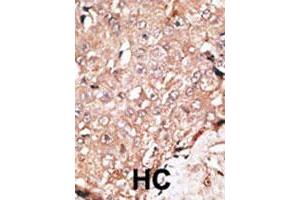 Formalin-fixed and paraffin-embedded human hepatocellular carcinoma tissue reacted with AOF2 polyclonal antibody , which was peroxidase-conjugated to the secondary antibody, followed by DAB staining. (LSD1 antibody  (C-Term))