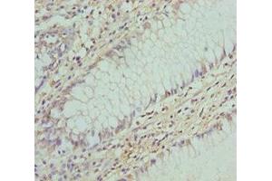 Immunohistochemistry of paraffin-embedded human colon cancer using ABIN7148460 at dilution of 1:100 (COG5 antibody  (AA 1-260))