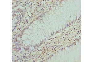 Immunohistochemistry of paraffin-embedded human colon cancer using ABIN7148460 at dilution of 1:100