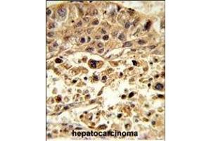 Formalin-fixed and paraffin-embedded human hepatocarcinoma reacted with VPS26A Antibody (Center), which was peroxidase-conjugated to the secondary antibody, followed by DAB staining. (VPS26A antibody  (AA 263-291))