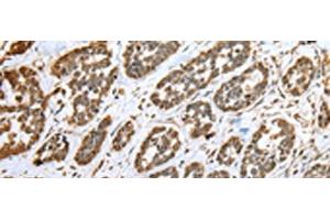 Immunohistochemistry of paraffin-embedded Human esophagus cancer tissue using CNPY2 Polyclonal Antibody at dilution of 1:25(x200) (CNPY2/MSAP antibody)