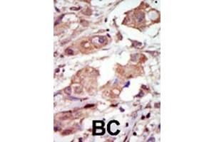 Formalin-fixed and paraffin-embedded human cancer tissue reacted with the primary antibody, which was peroxidase-conjugated to the secondary antibody, followed by DAB staining. (MAP3K10 antibody  (C-Term))