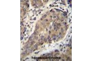WTIP Antibody (C-term) immunohistochemistry analysis in formalin fixed and paraffin embedded human hepatocarcinoma followed by peroxidase conjugation of the secondary antibody and DAB staining. (WTIP antibody  (C-Term))