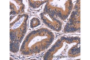 Immunohistochemistry of Human cervical cancer using SPATA7 Polyclonal Antibody at dilution of 1:30
