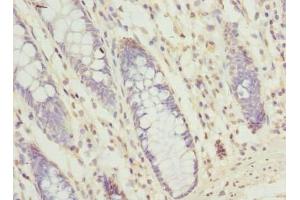 Immunohistochemistry of paraffin-embedded human colon cancer using ABIN7166217 at dilution of 1:100 (SEC61G antibody  (AA 1-32))