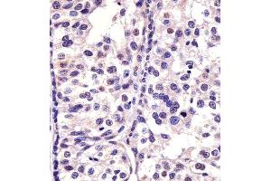 Paraformaldehyde-fixed, paraffin embedded human breast carcinoma, Antigen retrieval by boiling in sodium citrate buffer (pH6. (CDK4 antibody)