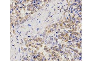 Immunohistochemistry of paraffin-embedded Human lung cancer using TNFRSF1B Polyclonal Antibody at dilution of 1:200 (40x lens). (TNFRSF1B antibody)