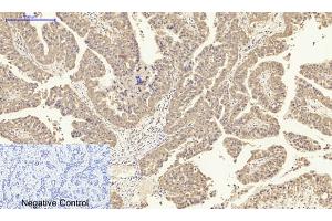 Immunohistochemical analysis of paraffin-embedded human liver cancer tissue. (IL-8 antibody  (C-Term))