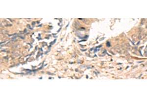 Immunohistochemistry of paraffin-embedded Human colorectal cancer tissue using ABHD2 Polyclonal Antibody at dilution of 1:40(x200)