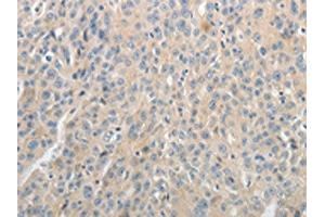 The image on the left is immunohistochemistry of paraffin-embedded Human ovarian cancer tissue using ABIN7189581(ABCB11 Antibody) at dilution 1/25, on the right is treated with synthetic peptide. (ABCB11 antibody)