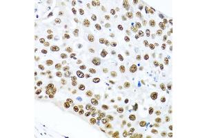 Immunohistochemistry of paraffin-embedded human lung cancer using METTL3 antibody (ABIN5974672) at dilution of 1/100 (40x lens). (METTL3 antibody)