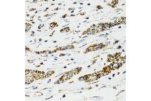 Immunohistochemistry of paraffin-embedded human breast cancer using HSPA9 antibody.