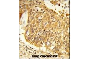 Formalin-fixed and paraffin-embedded human lung carcinoma reacted with EEFSEC Antibody (C-term), which was peroxidase-conjugated to the secondary antibody, followed by DAB staining.