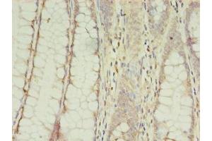 Immunohistochemistry of paraffin-embedded human colon cancer using ABIN7148535 at dilution of 1:100