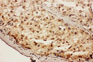 Anti-SIAH Interacting Protein antibody,IHC(P) IHC(P): Human Liver Cancer Tissue (CACYBP antibody  (Middle Region))