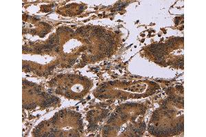 Immunohistochemistry of Human colon cancer using EDN2 Polyclonal Antibody at dilution of 1:30 (Endothelin 2 antibody)