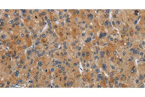 Immunohistochemistry of paraffin-embedded Human liver cancer tissue using FLCN Polyclonal Antibody at dilution 1:40