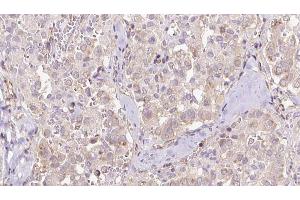 ABIN6273316 at 1/100 staining Human thyroid cancer tissue by IHC-P. (Seladin 1 antibody  (N-Term))