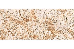 Immunohistochemistry of paraffin-embedded Human ovarian cancer tissue using HOXC12 Polyclonal Antibody at dilution of 1:50(x200) (HOXC12 antibody)