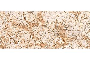 Immunohistochemistry of paraffin-embedded Human ovarian cancer tissue using HOXC12 Polyclonal Antibody at dilution of 1:50(x200)