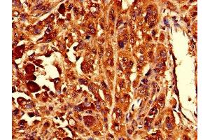 Immunohistochemistry of paraffin-embedded human melanoma using ABIN7142728 at dilution of 1:100 (RPL10L antibody  (AA 1-214))