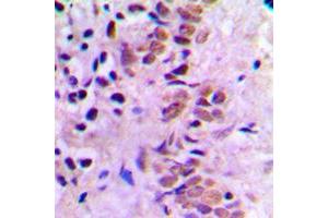 Immunohistochemical analysis of E2F1 staining in human breast cancer formalin fixed paraffin embedded tissue section.