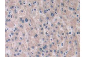 DAB staining on IHC-P; Samples: Human Liver cancer Tissue (PAFAH2 antibody  (AA 1-392))