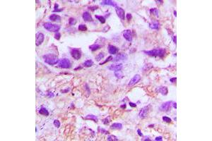 Immunohistochemical analysis of PDGFA staining in human lung cancer formalin fixed paraffin embedded tissue section.