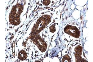 IHC-P Image ROCK1 antibody [N1N2], N-term detects ROCK1 protein at cytoplasm on human breast carcinoma by immunohistochemical analysis. (ROCK1 antibody  (N-Term))