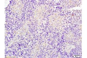 Formalin-fixed and paraffin embedded human glioma tissue labeled with Anti-JUP/Cateninma γ Polyclonal Antibody, Unconjugated at 1:200 followed by conjugation to the secondary antibody and DAB staining (JUP antibody  (AA 601-700))