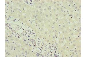 Immunohistochemistry of paraffin-embedded human liver cancer using ABIN7151202 at dilution of 1:100 (RNF5 antibody  (AA 1-120))