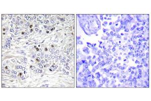 Immunohistochemistry analysis of paraffin-embedded human breast carcinoma tissue, using TEAD2 antibody. (TEAD2 antibody  (Internal Region))