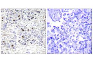 Immunohistochemistry analysis of paraffin-embedded human breast carcinoma tissue, using TEAD2 antibody.
