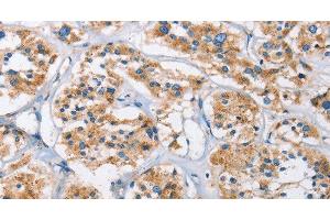 Immunohistochemistry of paraffin-embedded Human thyroid cancer using Cathepsin L Polyclonal Antibody at dilution of 1:40 (Cathepsin L antibody)