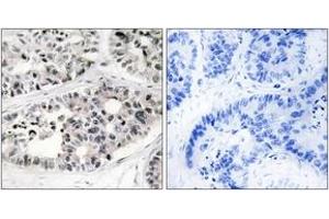 Immunohistochemistry analysis of paraffin-embedded human lung carcinoma tissue, using Collagen VII alpha1 Antibody. (COL7A1 antibody  (AA 1841-1890))