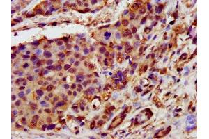 IHC image of ABIN7154521 diluted at 1:400 and staining in paraffin-embedded human pancreatic cancer performed on a Leica BondTM system. (GHITM antibody  (AA 293-345))