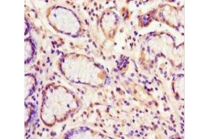Immunohistochemistry of paraffin-embedded human gastric cancer using ABIN7152221 at dilution of 1:100 (EIF6 antibody  (AA 1-245))