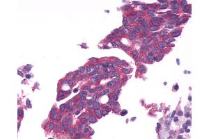 Anti-GPRC6A antibody IHC of human Ovary, Carcinoma. (GPRC6A antibody  (N-Term))