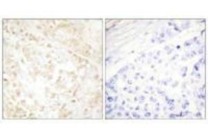 Immunohistochemistry analysis of paraffin-embedded human breast carcinoma tissue using XRCC6 antibody. (XRCC6 antibody  (C-Term))