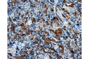 Immunohistochemical staining of paraffin-embedded Adenocarcinoma of colon tissue using anti-RC219453 mouse monoclonal antibody.