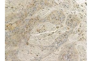 ABIN6260725 and ABIN6266688 at 1/100 staining human esophageal carcinoma by IHC-P.
