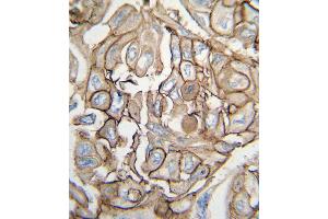 Formalin-fixed and paraffin-embedded human lung carcinoma tissue reacted with HRAS antibody , which was peroxidase-conjugated to the secondary antibody, followed by DAB staining.