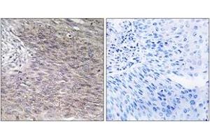 Immunohistochemistry analysis of paraffin-embedded human cervix carcinoma tissue, using CHSY2 Antibody. (CHPF antibody  (AA 631-680))
